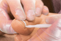 ONYCLIP Nagelspange