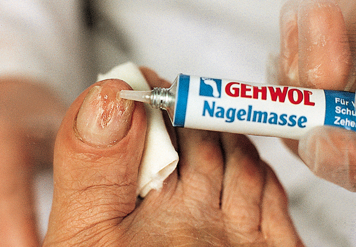 01_Therapie_und_Praevention_Nagelmasse-03