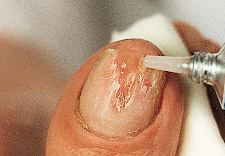 01_Therapie_und_Praevention_Nagelmasse-03