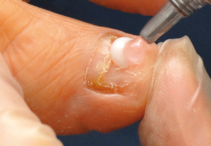 01_Therapie_und_Praevention_Nailrepair-02