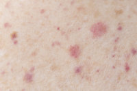 Scabies