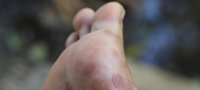 HandFussSyndrom_nach_Chemotherapie