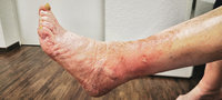 Behandlung von Patienten mit einem Erysipel (Wundrose)