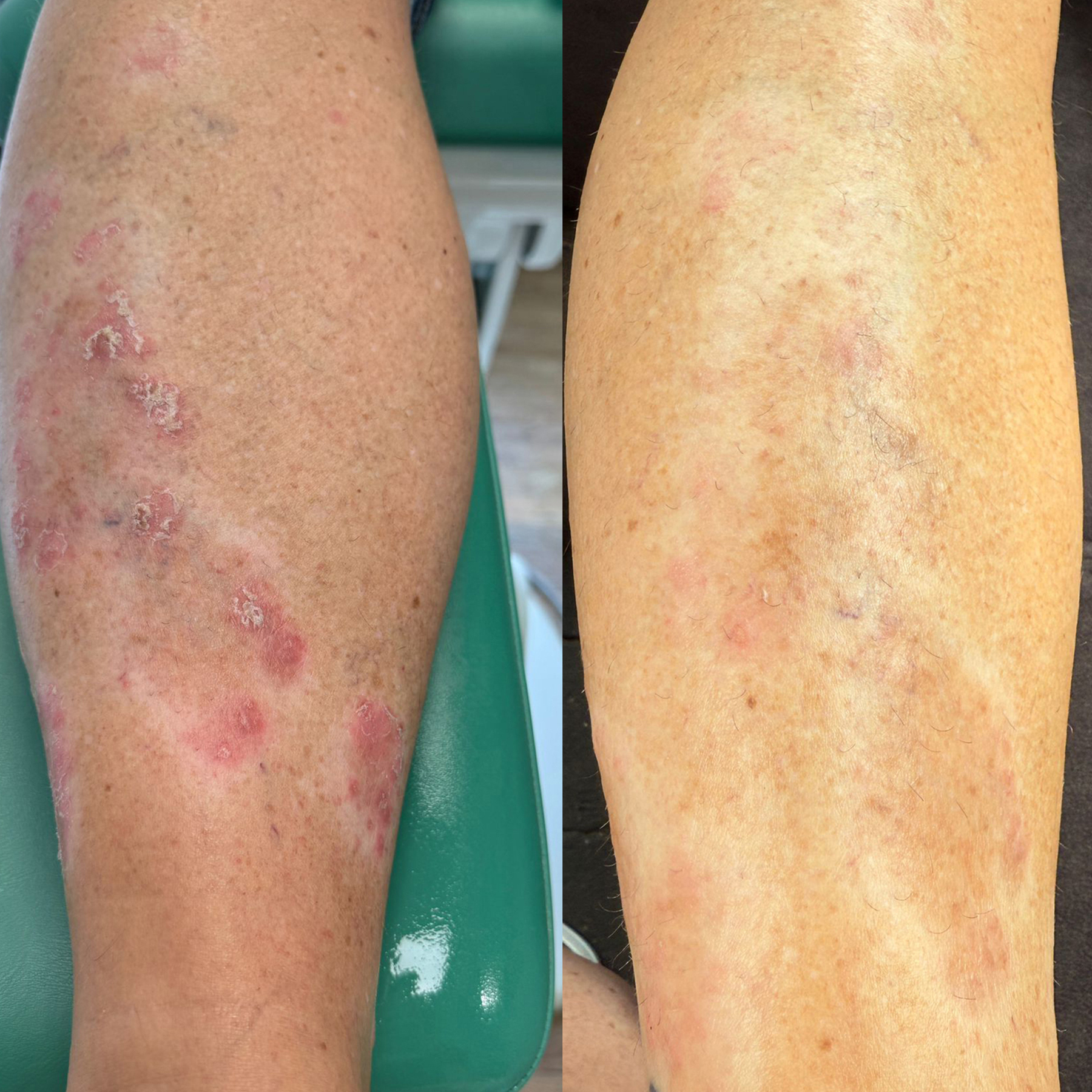 Bild2_Beispiel 2: Neurodermitis